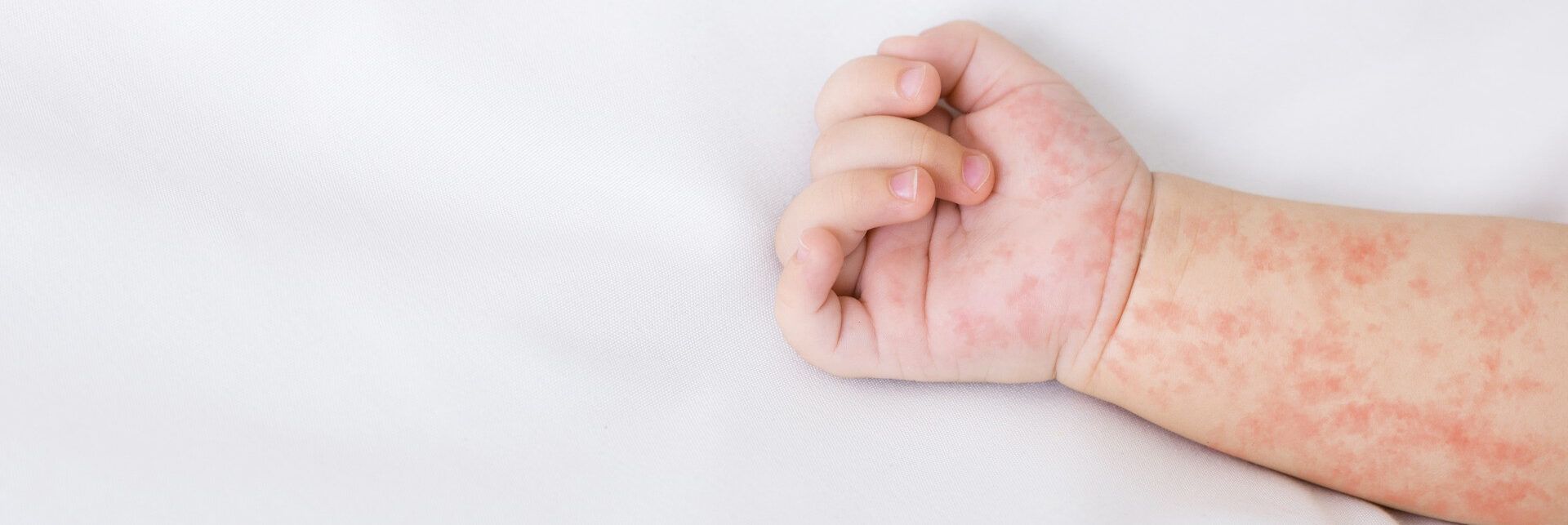 Casi di morbillo in aumento, ecco le cause