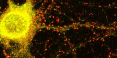 Scoperto un nuovo gene alla base dell'Alzheimer