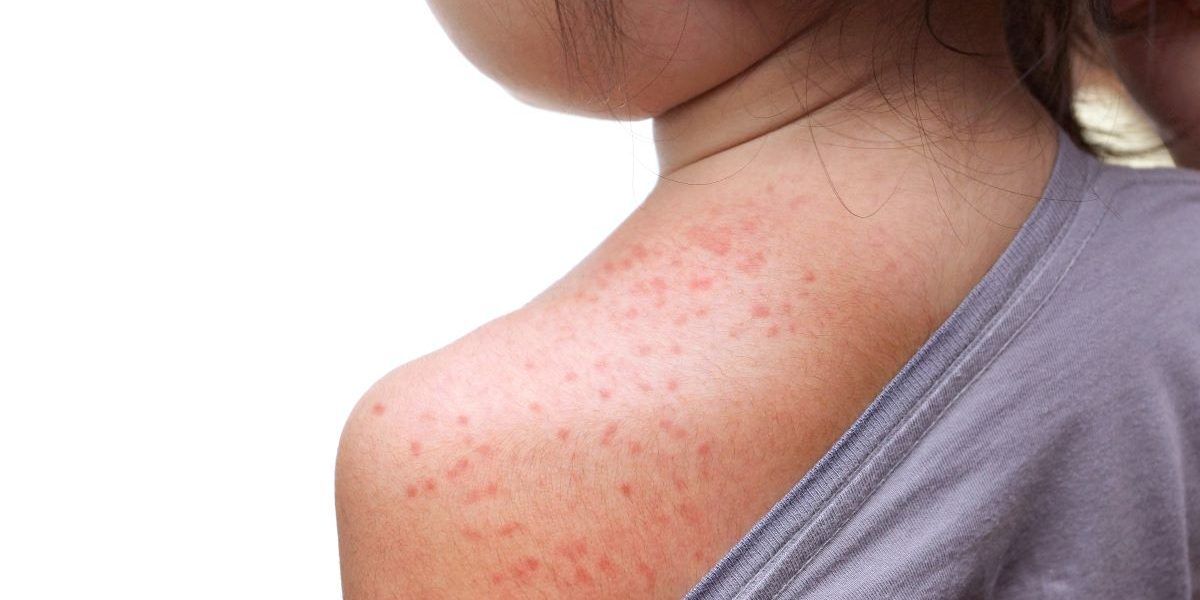 Iss: «459 casi di morbillo in Italia (376 non vaccinati). In Calabria l’incidenza più elevata»