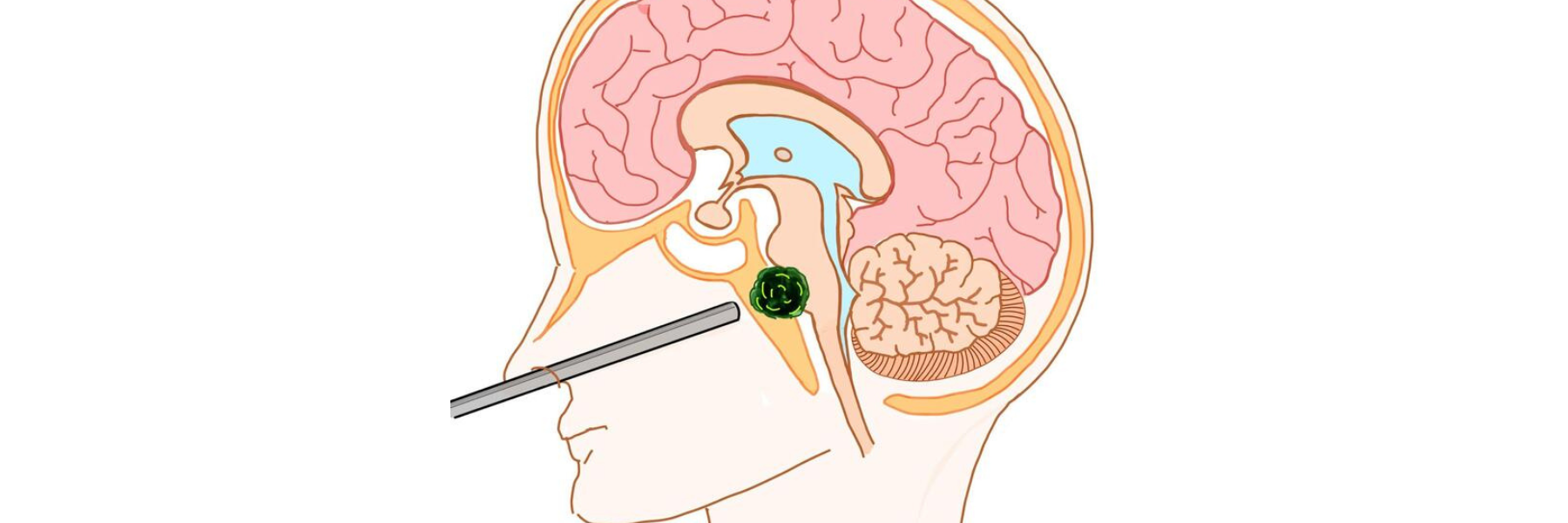 Operata per un tumore intracranico, poi il parto