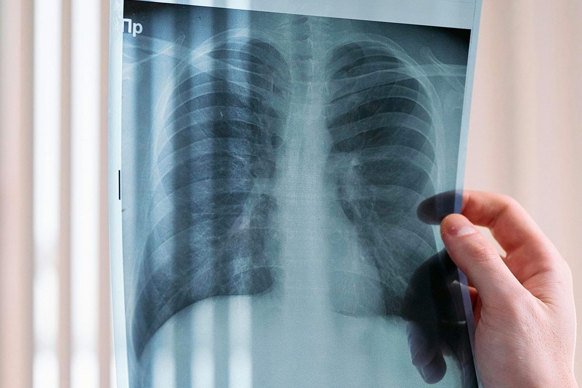 Artrite reumatoide e malattie polmonare, arrivano le prime linee guida ufficiali