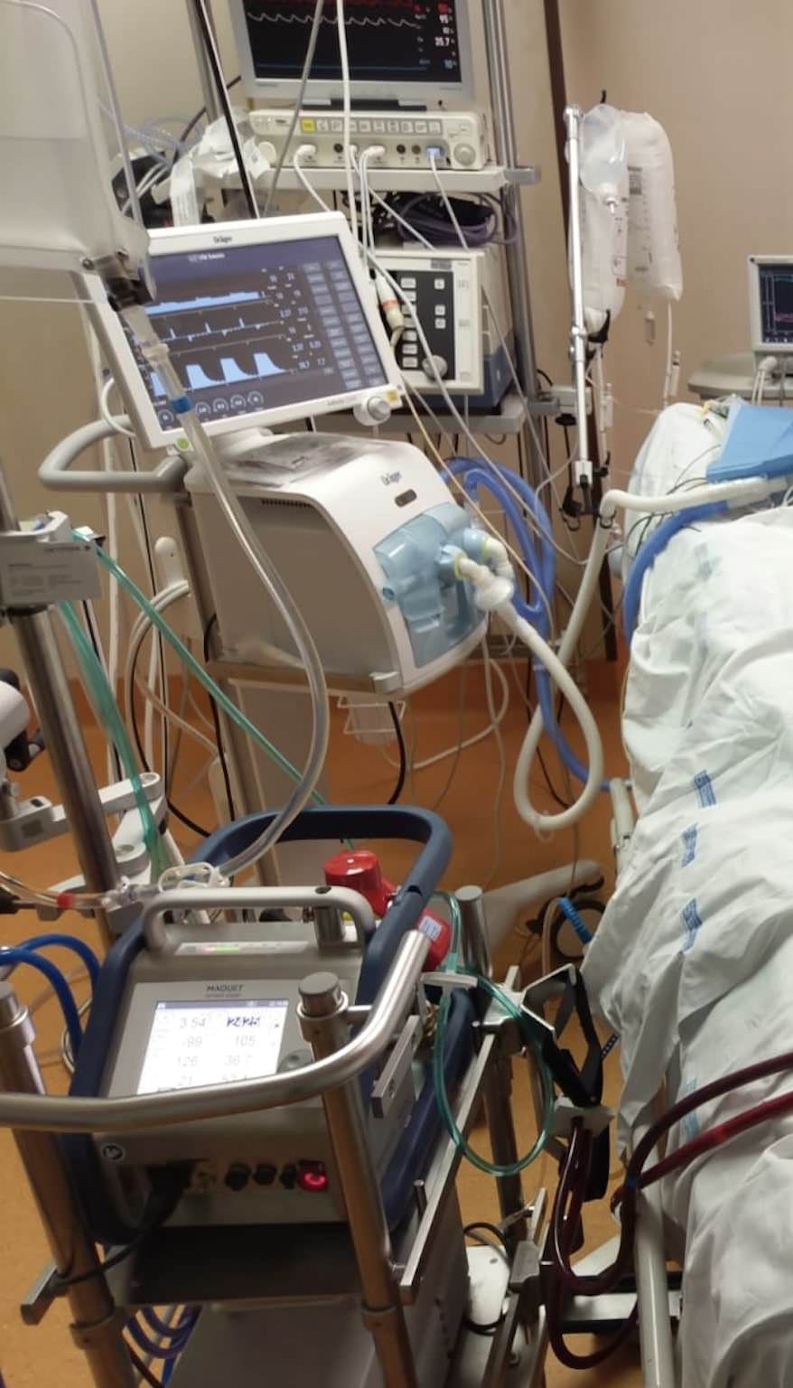 Catanzaro, paziente salvata grazie a un "cuore artificiale" prima del trapianto