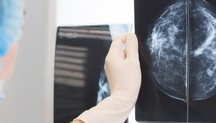 Tumori ginecologici e mammari, ogni anno in Italia 71 mila nuovi casi