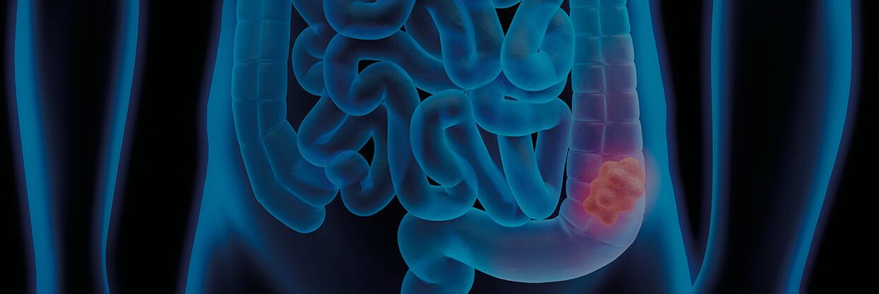 Cancro del colon-retto, colpito più di un italiano ogni mille