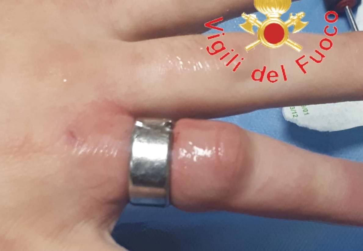 Catanzaro, anello troppo stretto al dito: lo tagliano i Vigili del Fuoco