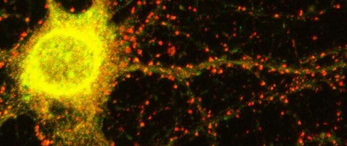Scoperto un nuovo gene alla base dell’Alzheimer