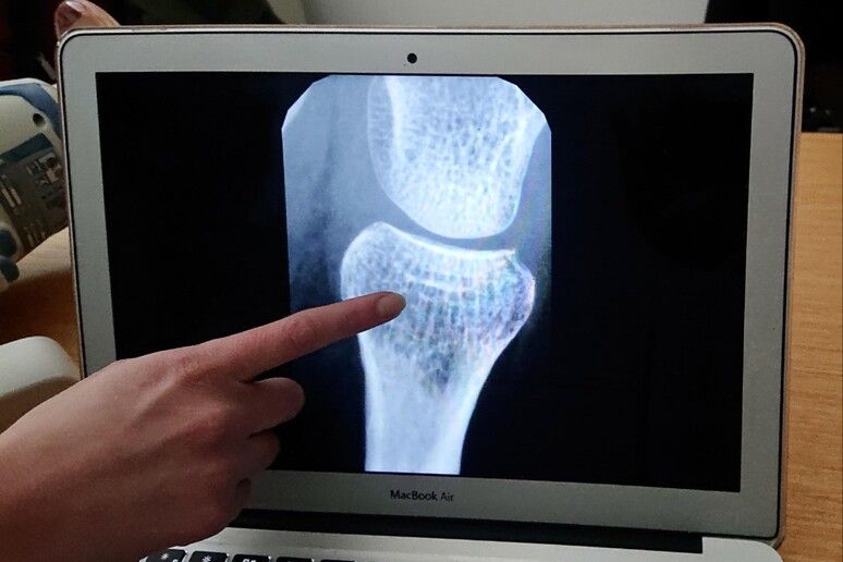 Una “pepita d’oro” contro l’osteoporosi, stimola la crescita delle ossa