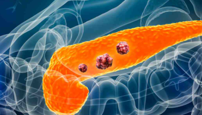 Tumore al pancreas, nuova scoperta: una proteina lo rende resistente ai farmaci