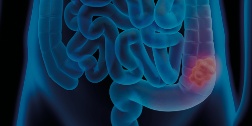 Carcinoma del colon retto