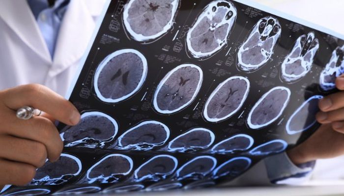 Catanzaro, la neurologia guarda al futuro tra cure e intelligenza artificiale