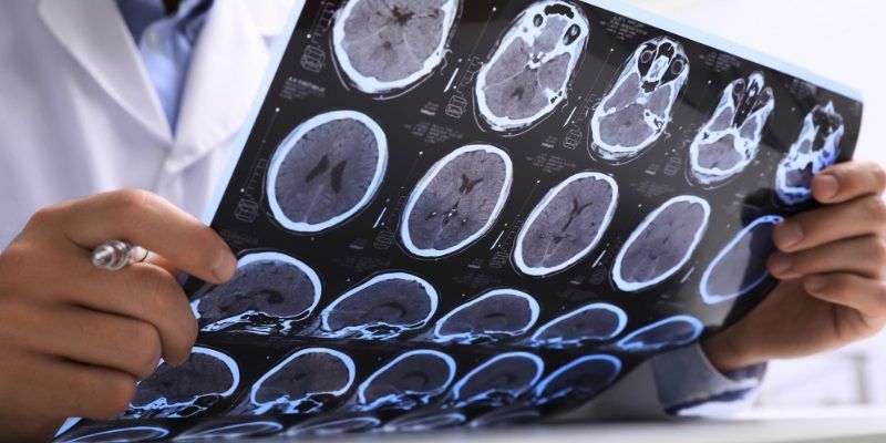 Disturbi neurologici, creati neuroni che aiutano a mantenere la calma