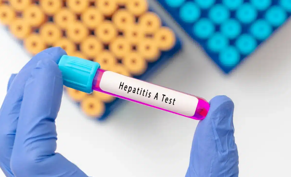 Epatite A, dati in aumento in tutta Italia: segnalati casi anche in Calabria