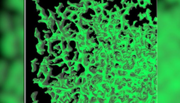 Forma del cancro svelata in tre dimensioni: la struttura nascosta delle metastasi