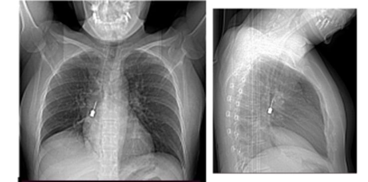 Intervento eccezionale della Chirurgia Toracica del Gom, rimosso un cacciavite odontoiatrico incastrato in un bronco