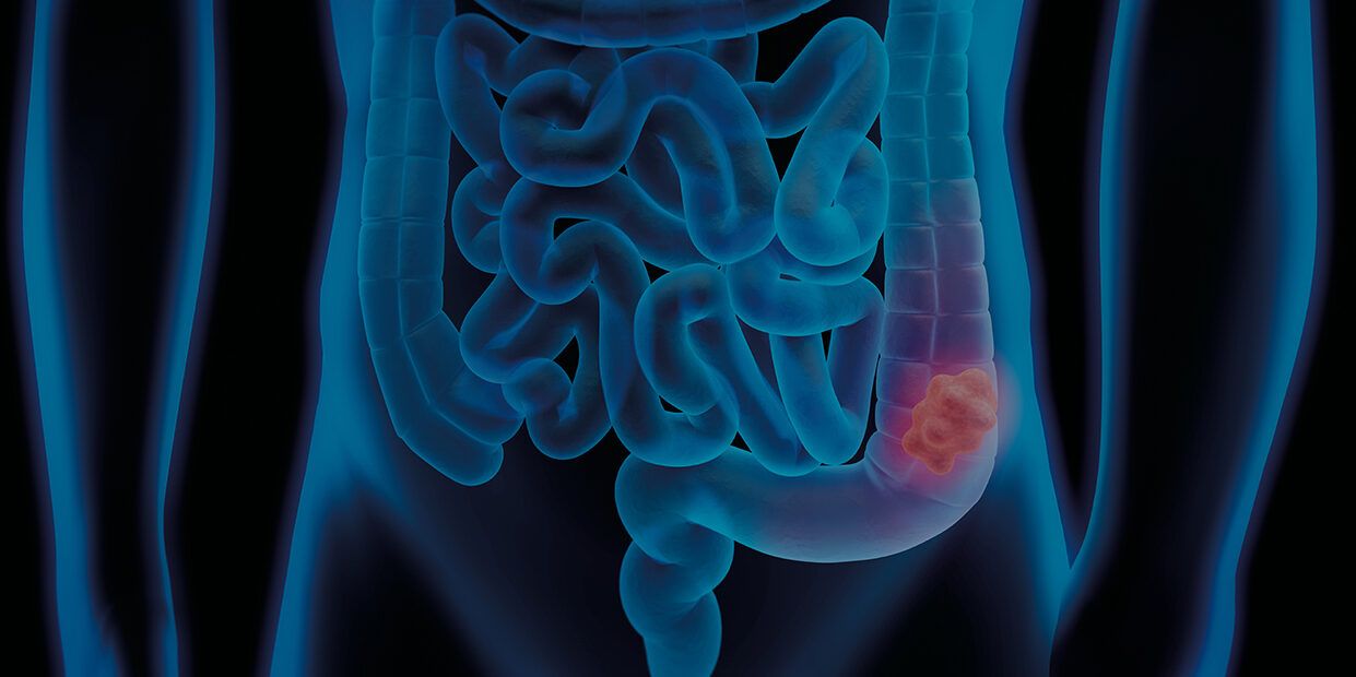 Tumore al colon retto, dalla Calabria arriva un messaggio cruciale sul valore della diagnosi precoce