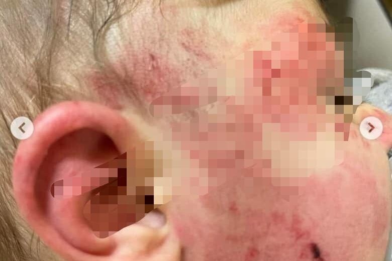 Palmi, bimbo aggredito a pugni e morsi mentre è all’asilo. «Dov’erano le maestre?»