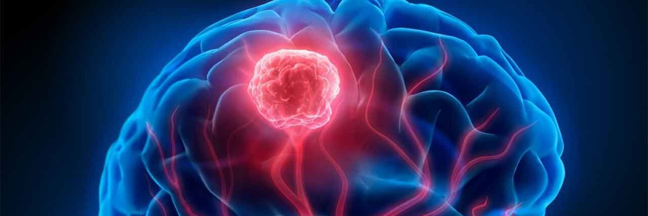 Glioblastoma, nuove prospettive da immunoterapia personalizzata