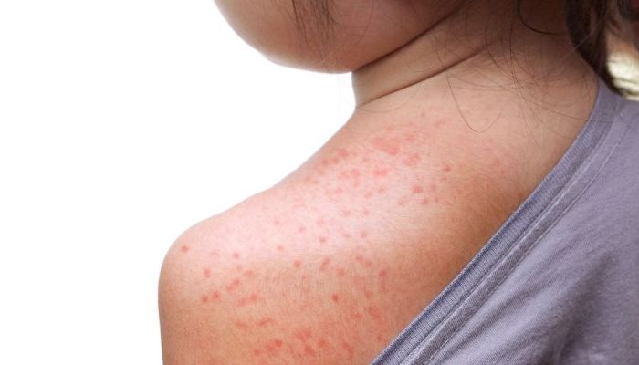 Nel 2025, 485 casi di morbillo in Italia