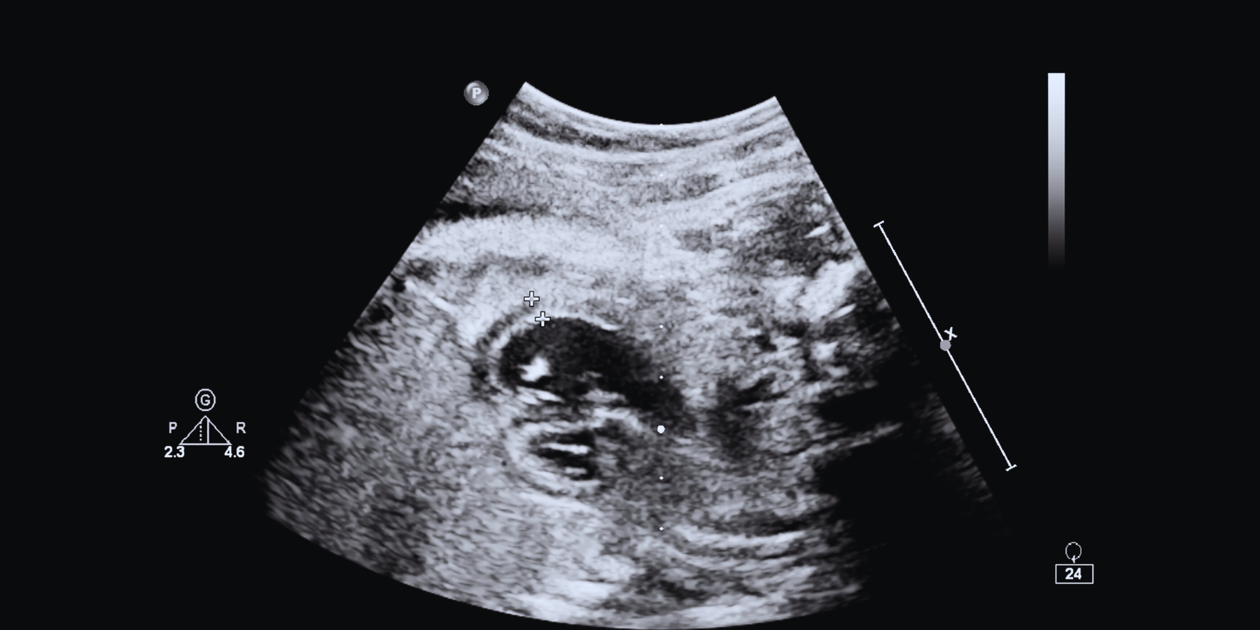 Un algoritmo individua anomalie celebrali fetali al primo trimestre di gravidanza