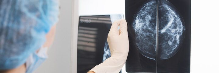 Tumore al seno, meno chemioterapia grazie all’oncologia di precisione