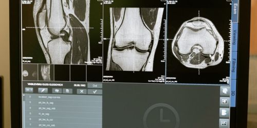 embolizzazione delle arterie genicolari