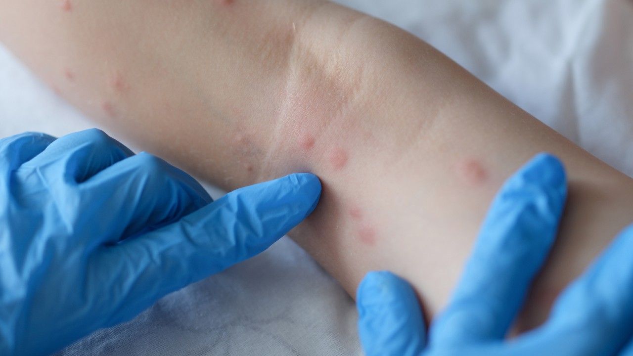 Vaiolo delle scimmie, Calabria ancora indenne