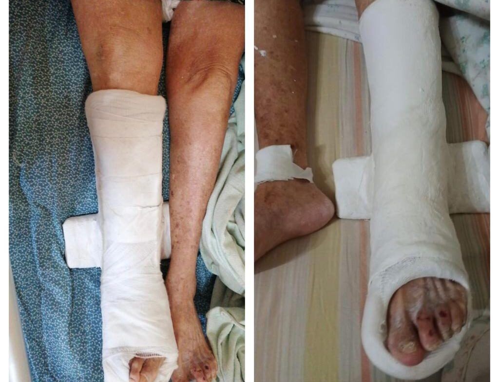 L’odissea di una centenaria: si rompe il femore e all’ospedale di Lamezia le ingessano la gamba sbagliata