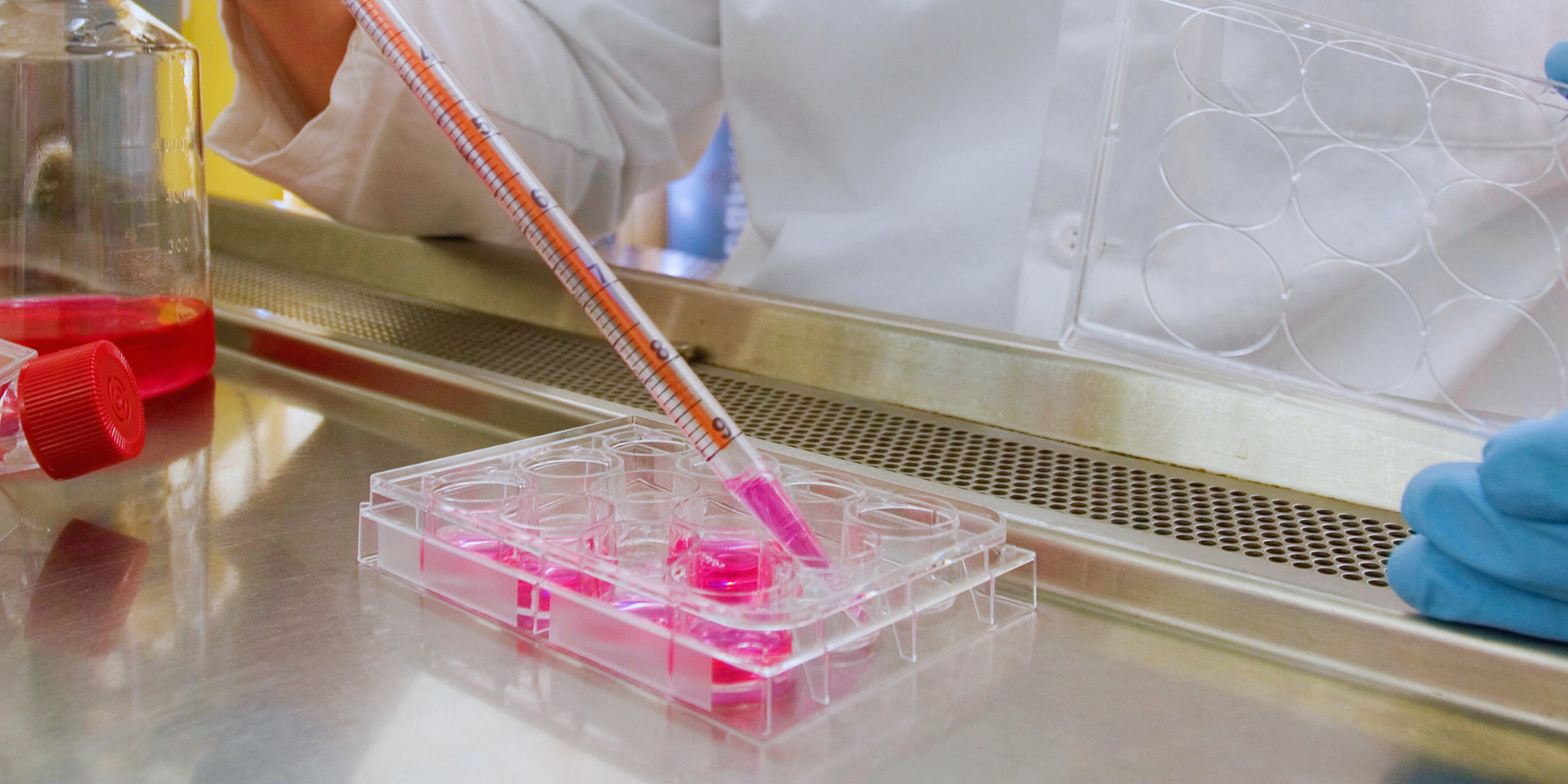 Staminali per combattere il Parkinson, al via il primo trattamento