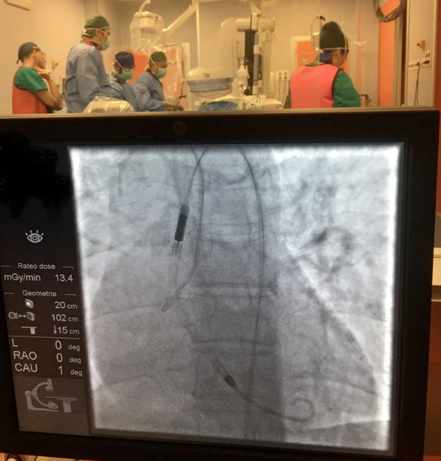 Cardiologia, intervento innovativo all’Annunziata di Cosenza