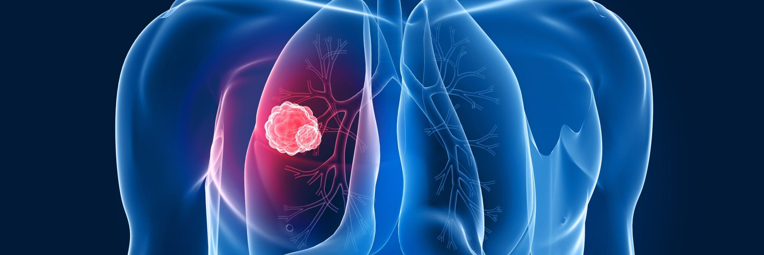 Carcinoma polmonare, con screening stimato aumenta la sopravvivenza