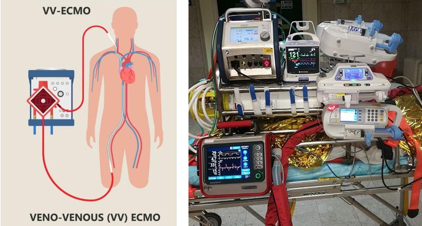 ECMO, Catanzaro rafforza il centro salvavita: approvato il nuovo PDTA