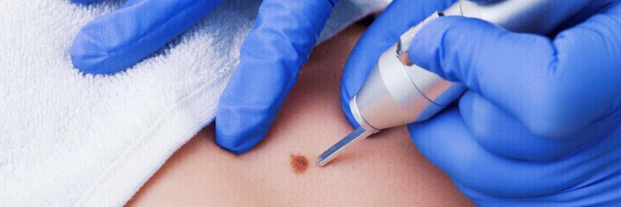 Morì dopo l’asportazione di un neo, chiesti 16 anni per il “santone”