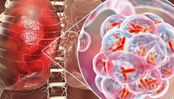 Tubercolosi, allarme per 1,2 milioni di bambini