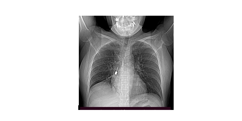 Intervento eccezionale della Chirurgia Toracica del Gom, rimosso un cacciavite odontoiatrico incastrato in un bronco