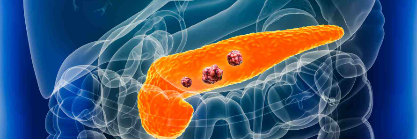 Tumore al pancreas, scoperta molecola “resistente”