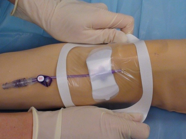 Niente cateteri, a Corigliano-Rossano chemioterapia a rischio per i malati oncologici