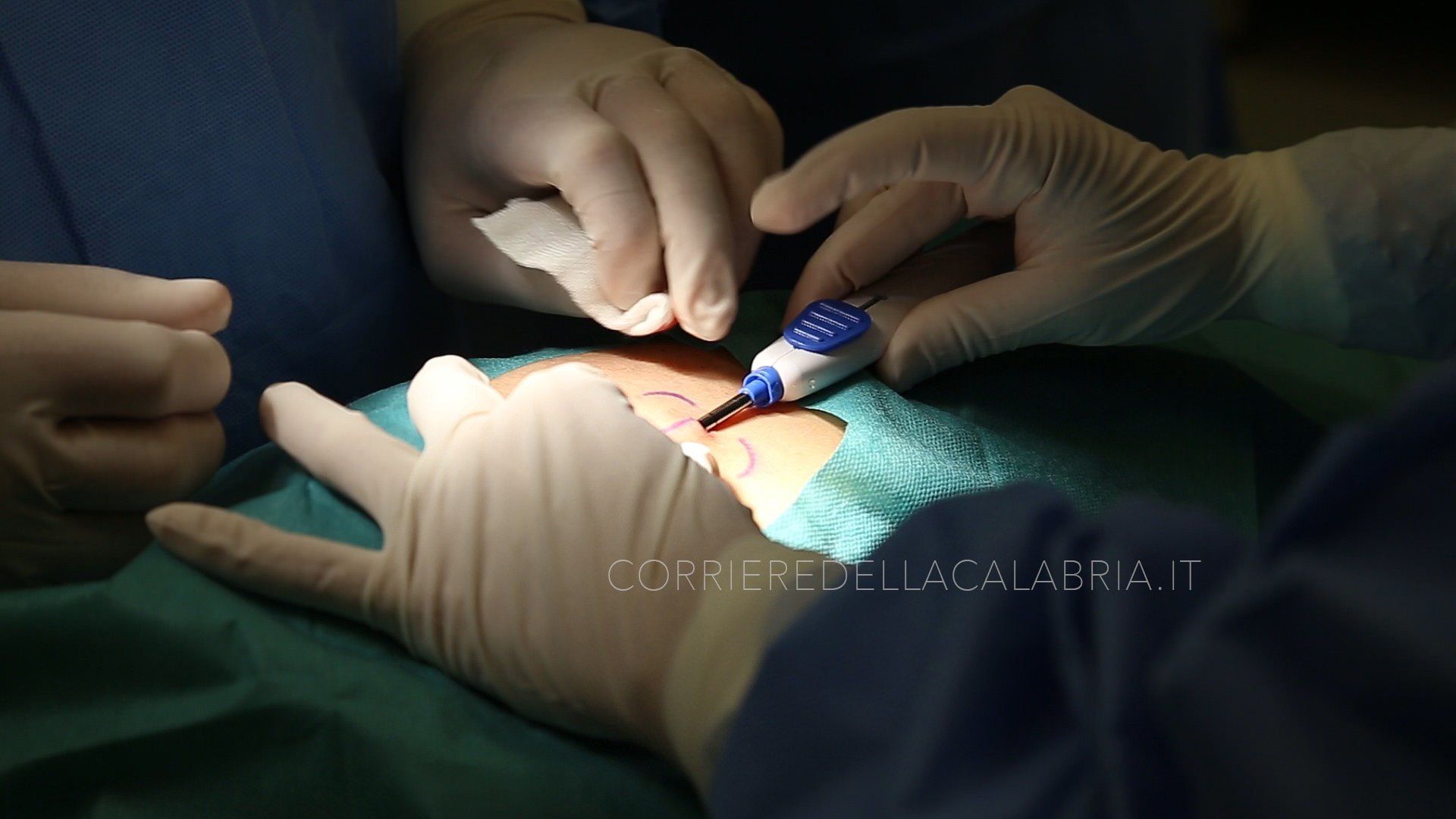 Al "Mater Domini" la rivoluzione per i malati di diabete