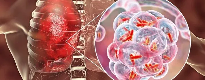 Tubercolosi, allarme per 1,2 milioni di bambini