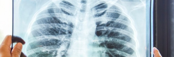 «La tubercolosi è la principale minaccia infettiva»