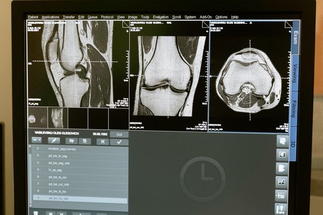 Stop al dolore al ginocchio senza bisturi: l’Annunziata lancia la tecnica mini-invasiva