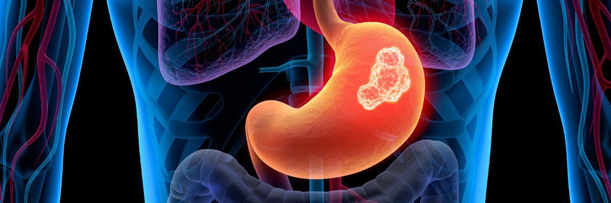 Cancro allo stomaco: nasce un’arma terapeutica innovativa