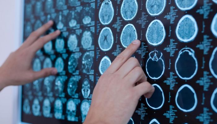 Uno studio rivela nuovi geni legati alla Sla