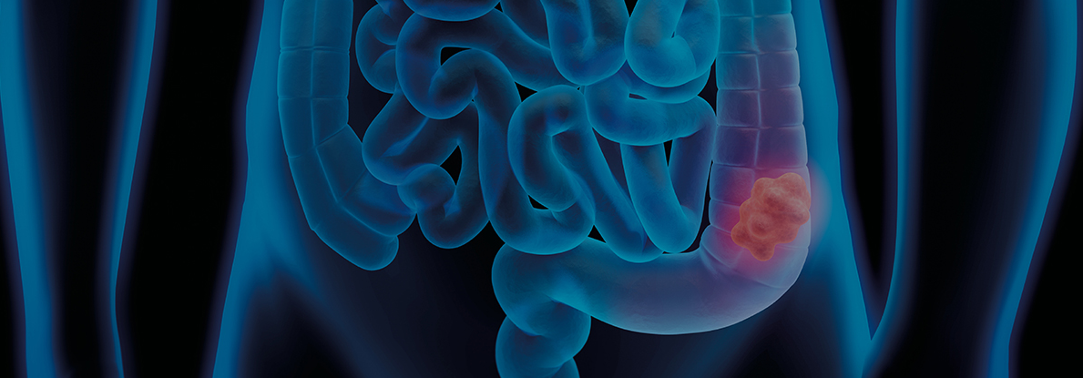 Carcinoma del colon retto, ora la prevenzione è “green”